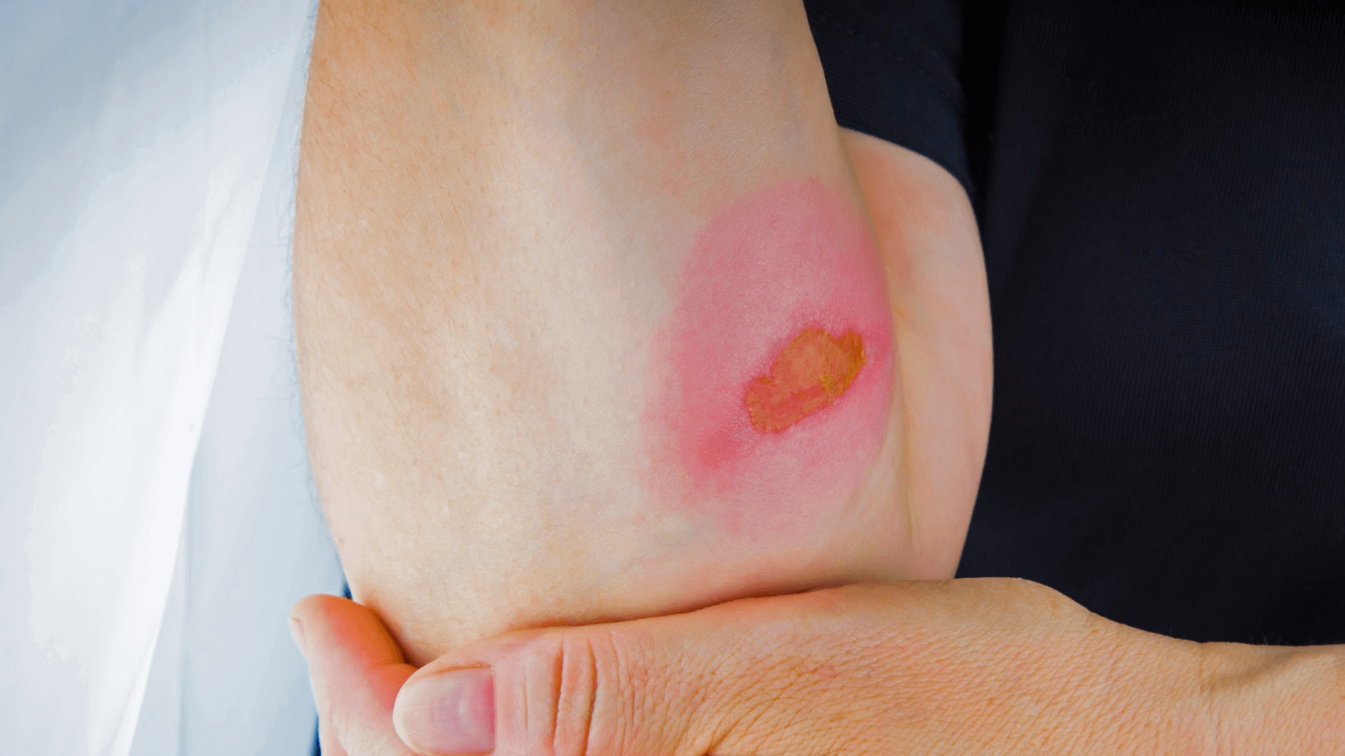 Bedsores (Pressure Ulcers) Condition, Treatments and Pictures for